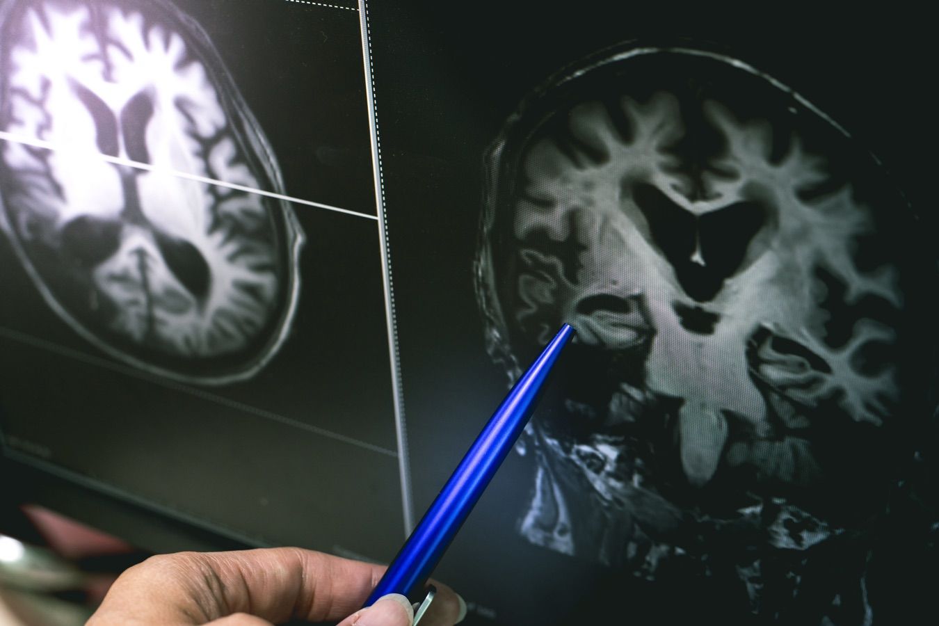 Meningiomas - Dr. Heros Almeida - Neurocirurgião em São Paulo