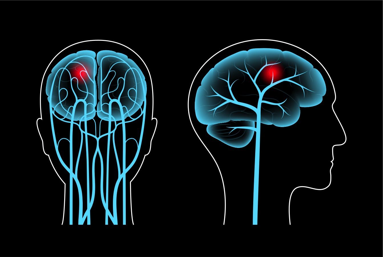 Malformações arteriovenosas - Dr. Heros Almeida - Neurocirurgião em São Paulo