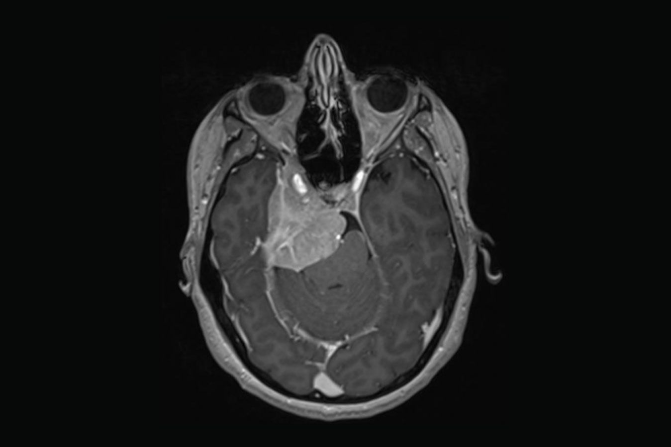 Meningiomas - Dr. Heros Almeida - Neurocirurgião em São Paulo