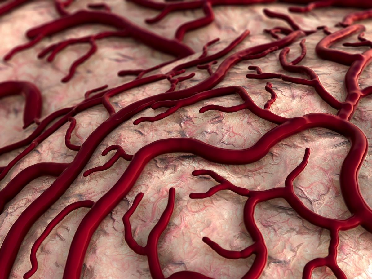 Malformações arteriovenosas - Dr. Heros Almeida - Neurocirurgião em São Paulo
