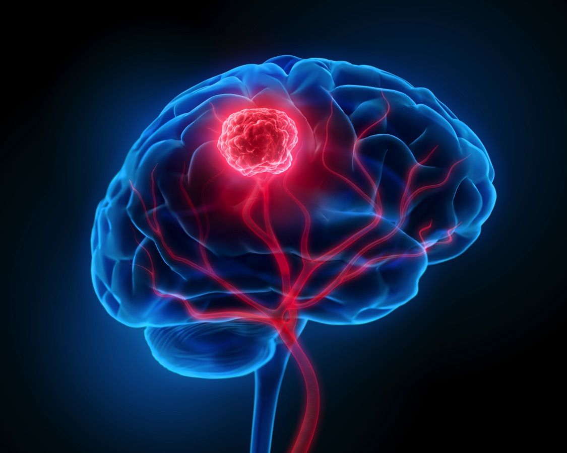 Neurocirurgia Vascular Intracraniana - Dr. Heros Almeida - Neurocirurgião em São Paulo