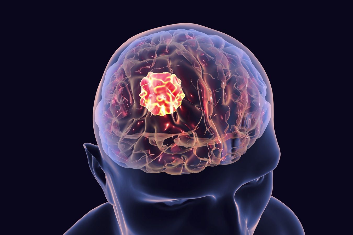 Gliomas - Dr. Heros Almeida - Neurocirurgião em São Paulo