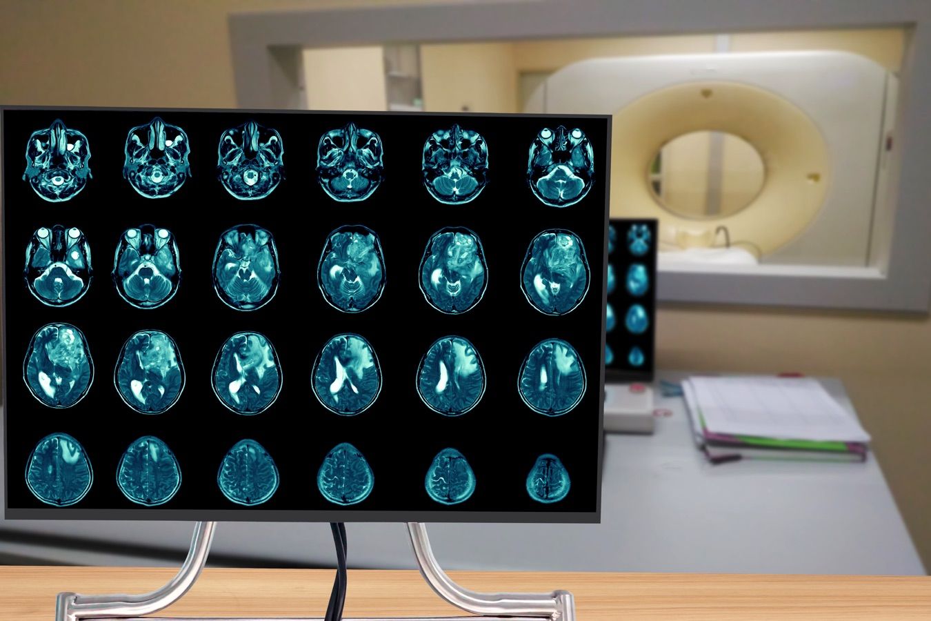 Metástases - Dr. Heros Almeida - Neurocirurgião em São Paulo