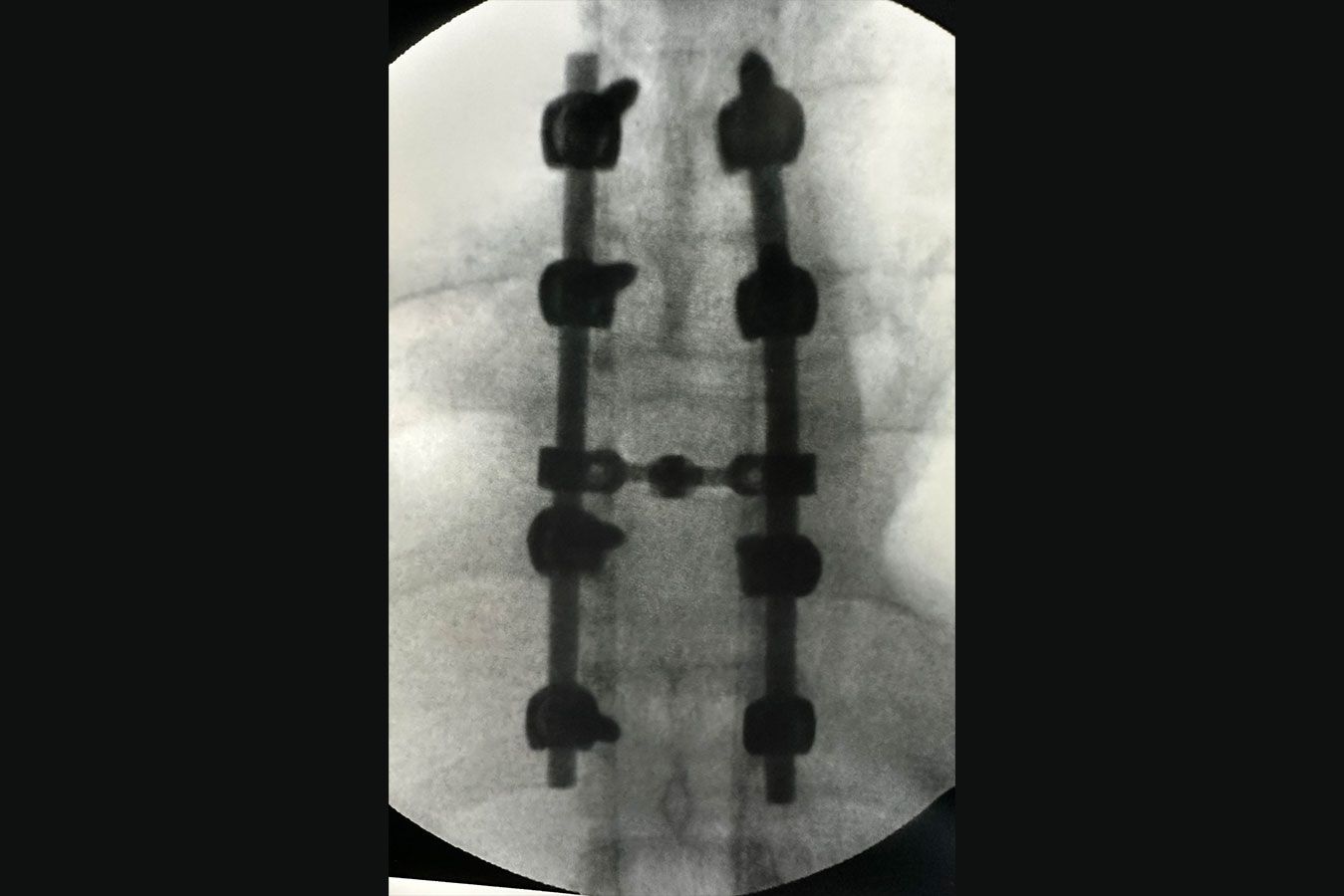Artrodese da coluna - Dr. Heros Almeida - Neurocirurgião em São Paulo