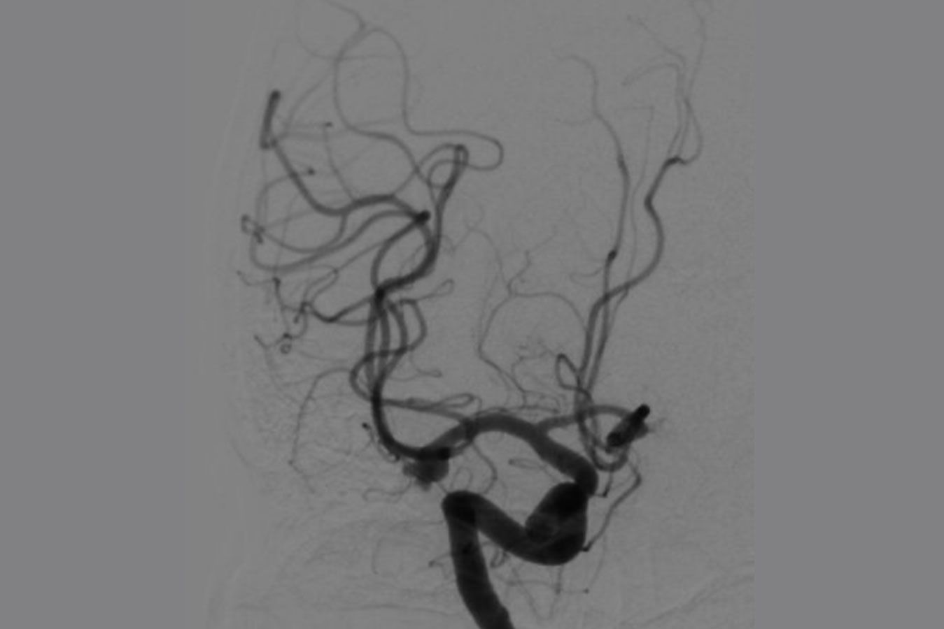 Aneurismas cerebrais - Dr. Heros Almeida - Neurocirurgião em São Paulo