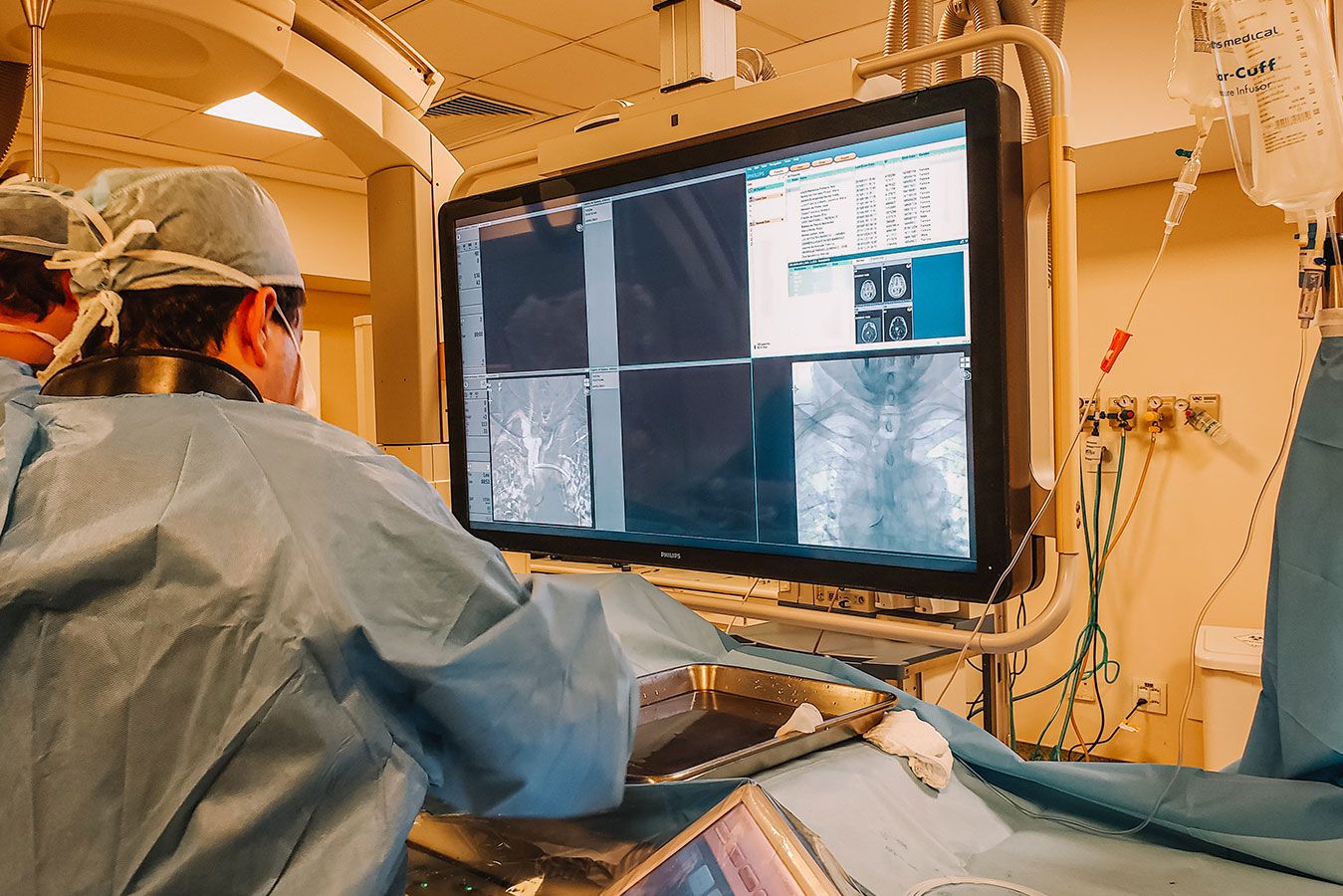 Tratamento endovascular - Dr. Heros Almeida - Neurocirurgião em São Paulo