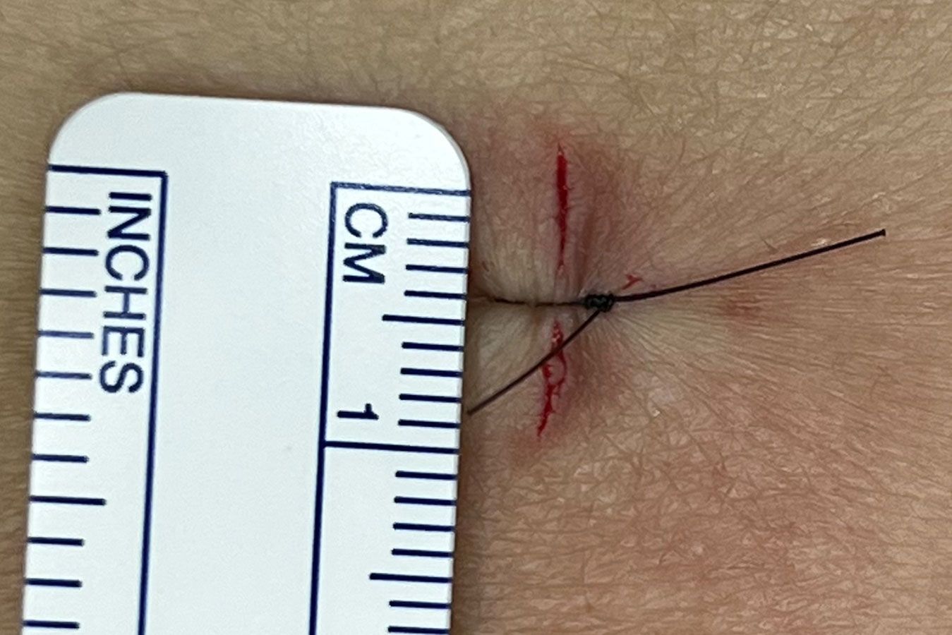 Cirurgia endoscópica da coluna - Dr. Heros Almeida - Neurocirurgião em São Paulo