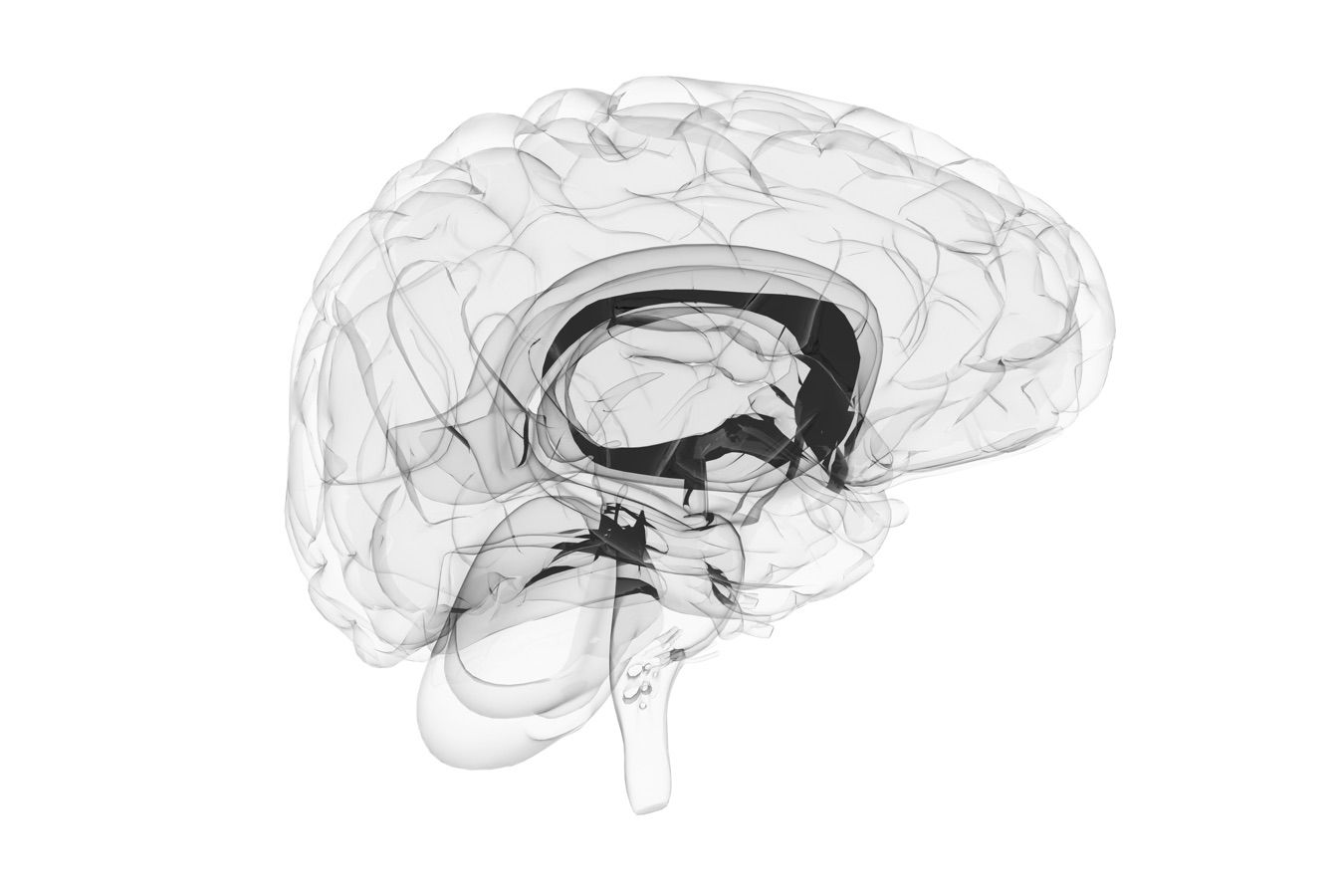 Neurinoma do acústico - Dr. Heros Almeida - Neurocirurgião em São Paulo