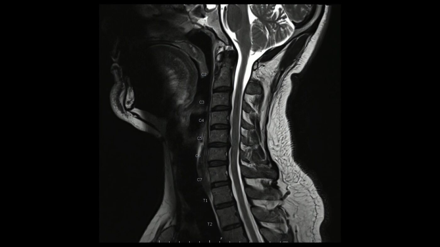 Cirurgias da Coluna - Dr. Heros Almeida - Neurocirurgião em São Paulo