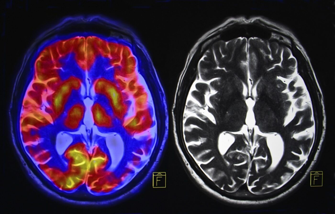 Neurocirurgia Vascular Intracraniana - Dr. Heros Almeida - Neurocirurgião em São Paulo